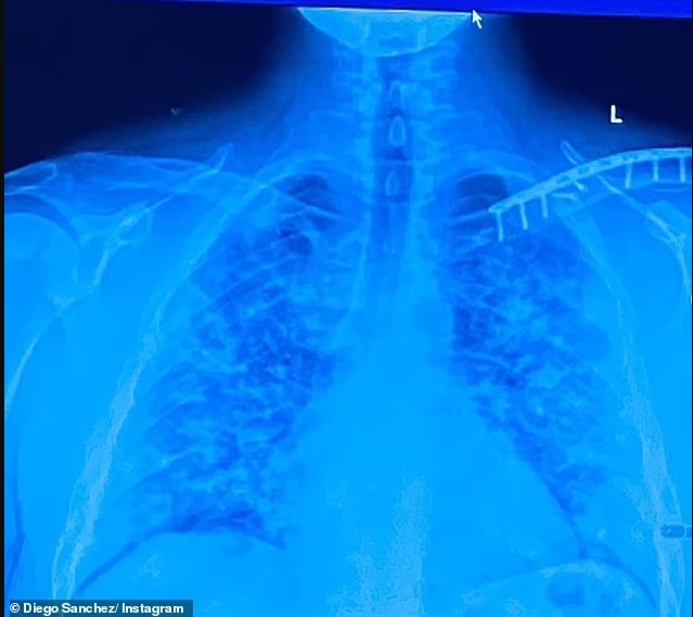  UFC legend Diego Sanchez ravaged by Covid with blot clots in both legs and pneumonia (photos)